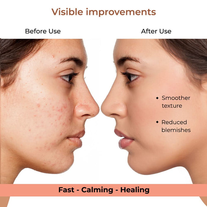 bbold Dissolvable Microneedle Acne Patch | Targets Pimples at the Root | Ultra - Thin, Invisible & Makeup - Friendly | Hyaluronic Acid & Salicylic Acid | Heals in 6 - 8 Hours | Each Pack Has 9 Pcs - Azistastore