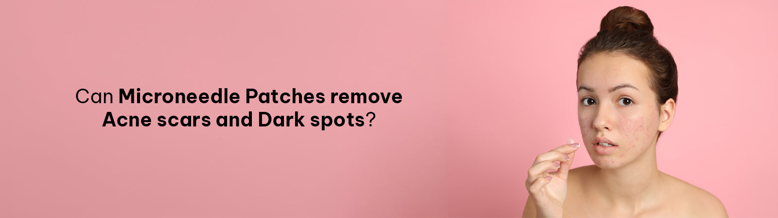 Can Microneedle Patches remove Acne scars and Dark spots?